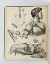 A TREATISE ON OPERATIVE SURGERY; COMPRISING A DESCRIPTION OF THE VARIOUS PROCESSES OF THE ART, INCLUDING ALL THE NEW OPERATIONS ; EXHIBITING THE STATE OF SURGICAL SCIENCE IN ITS PRESENT ADVANCED CONDITION: WITH EIGHTY PLATES CONTAINING FOUR HUNDRED AND EI