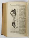 A SYSTEM OF SURGERY; PATHOLOGICAL, DIAGNOSTIC, THERAPEUTIC, AND OPERATIVE. ILLUSTRATED BY NINE HUNDRED AND THIRTY-SIX ENGRAVINGS [Two Volumes]